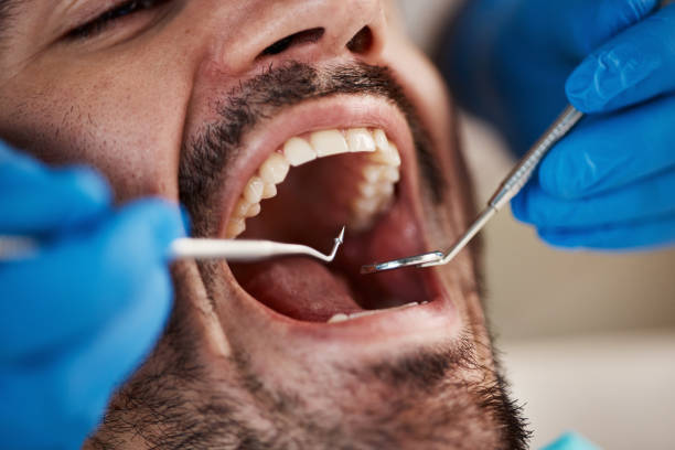 Best Chipped Tooth Repair Near Me  in Wetumpka, AL