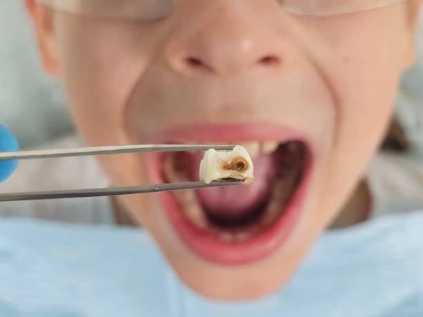 Best Knocked-Out Tooth Emergency  in Wetumpka, AL
